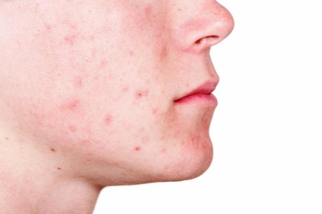 Thâm đỏ sau mụn: Nguyên nhân và sản phẩm điều trị thâm hiệu quả