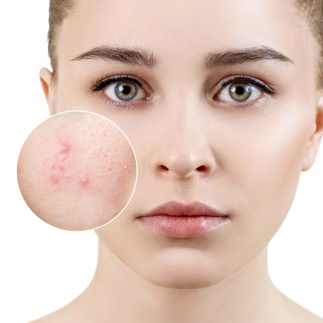 Bị mụn bọc có để lại sẹo? Đâu là cách trị mụn bọc hiệu quả?