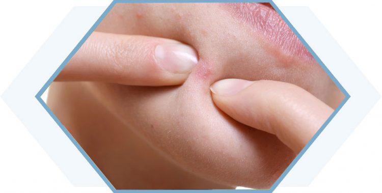 Mụn ẩn ở cằm do đâu? Cách điều trị như thế nào?