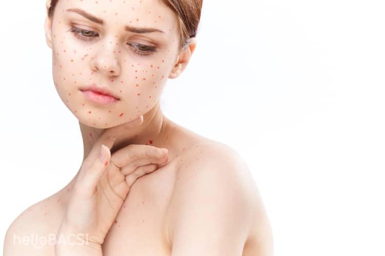 Những triệu chứng rubella đặc biệt cần lưu tâm