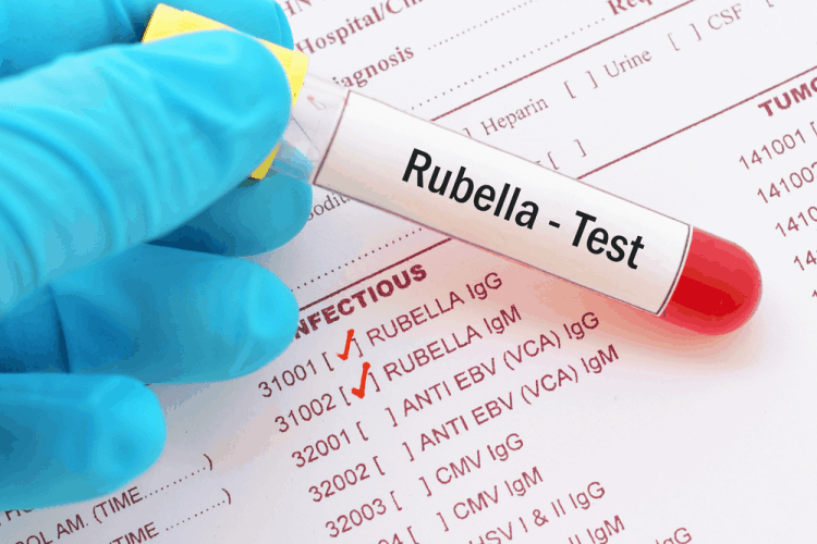Giải thích chi tiết kết quả xét nghiệm rubella IgM và IgG