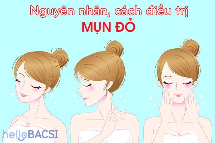Mụn đỏ sưng tấy: Nguyên nhân và Cách điều trị dứt điểm