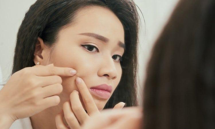 Nặn mụn là thói quen xấu gây mụn cám