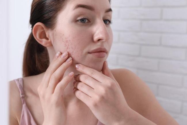5 cách trị mụn nhọt tại nhà hiệu quả chỉ sau 1 đêm