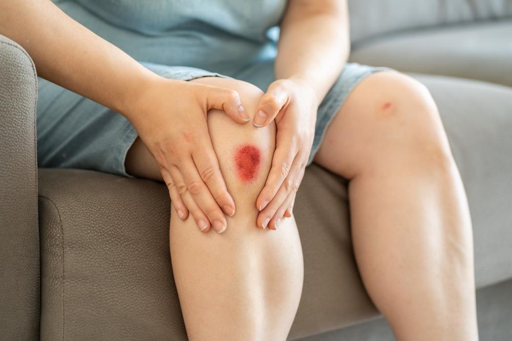 vi khuẩn ăn thịt người