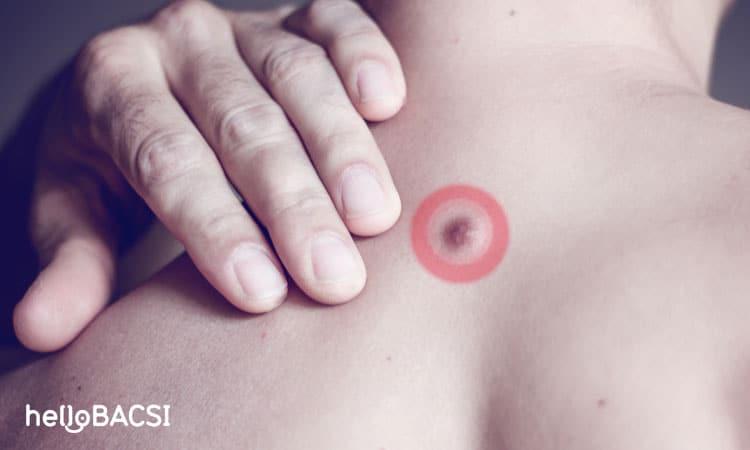 Cách trị mụn nang tại nhà