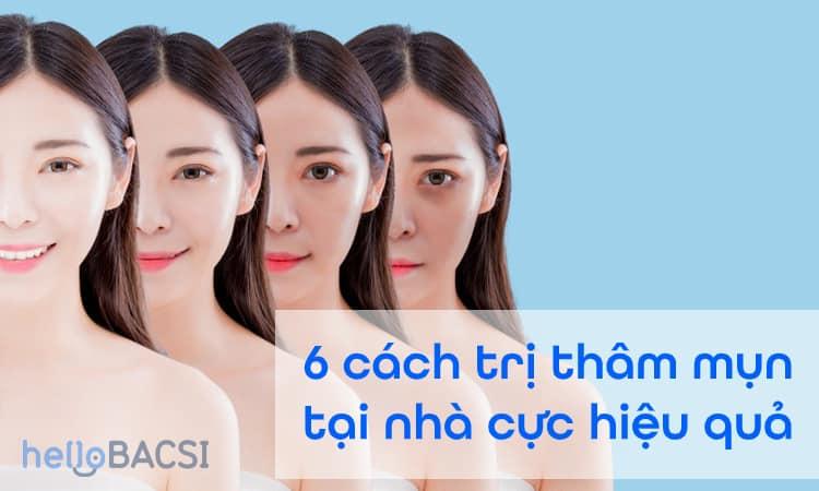 Cách trị thâm đỏ sau khi nặn mụn – Tránh viêm nhiễm