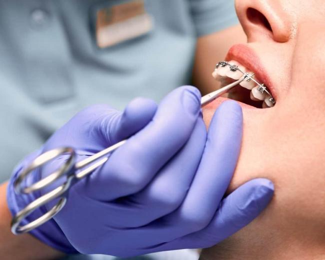 Những tác hại của niềng răng là gì?