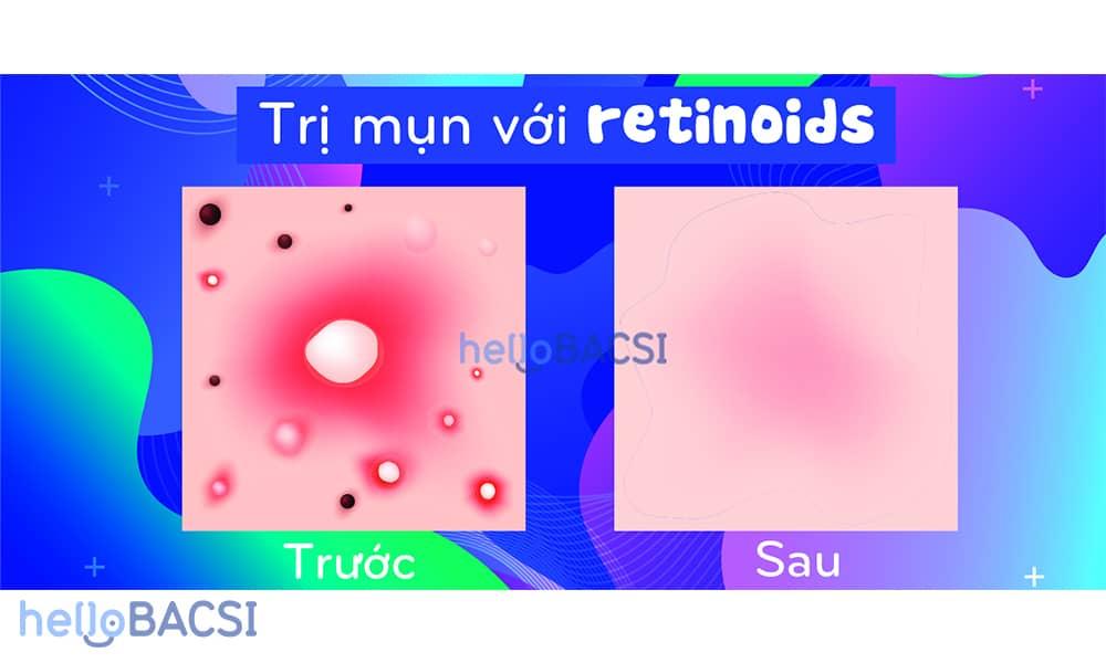 Trị mụn bọc bằng retinoids