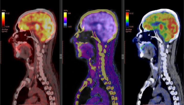 Chụp cắt lớp vi tính phát xạ đơn (spect) • Hello Bacsi