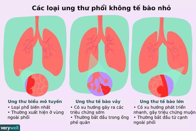 ung thư phổi không tế bào nhỏ