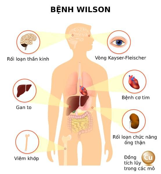 7. Phòng ngừa bệnh Wilson