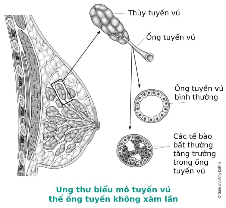 ung thư biểu mô ống tuyến vú