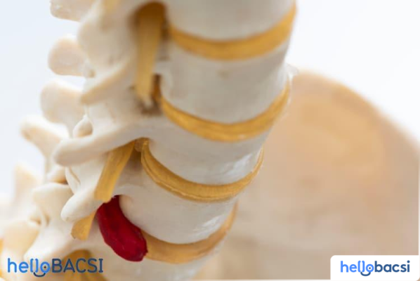 Rách đĩa đệm: Triệu chứng, nguyên nhân, chẩn đoán và điều trị