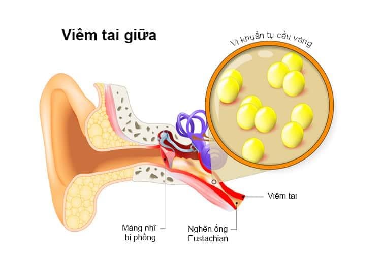 Dấu hiệu viêm tai giữa dễ nhận biết và biến chứng của bệnh