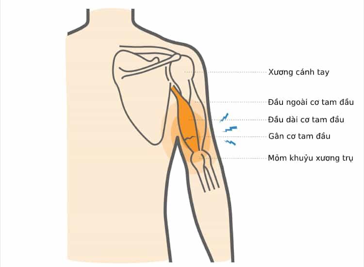 rách cơ tam đầu ở cánh tay