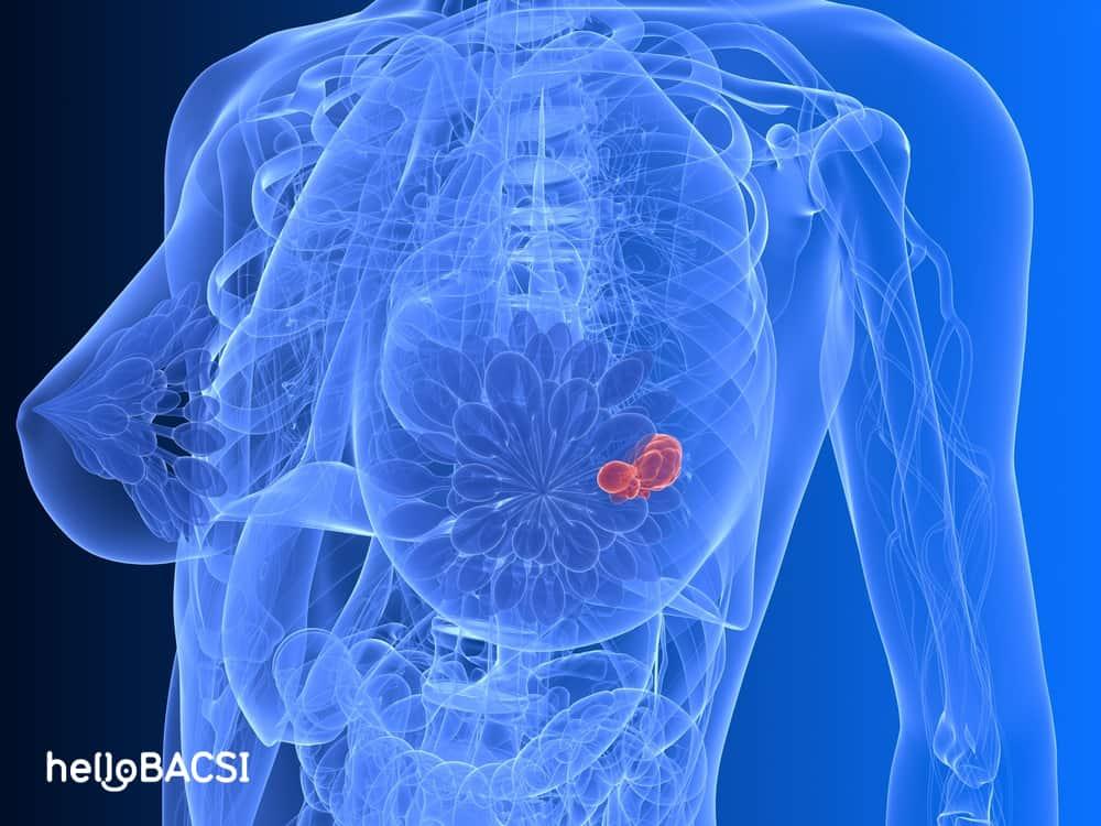 Thay đổi sợi bọc tuyến vú