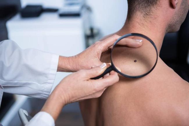 Nốt ruồi bị ngứa: Khi nào cảnh báo ung thư da?