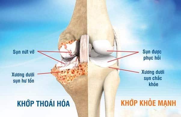 thoái hóa khớp gối