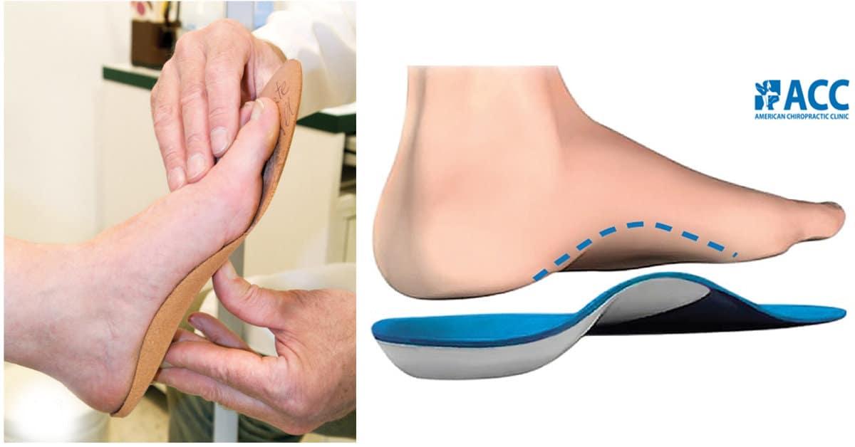 bàn chân bẹt ở trẻ