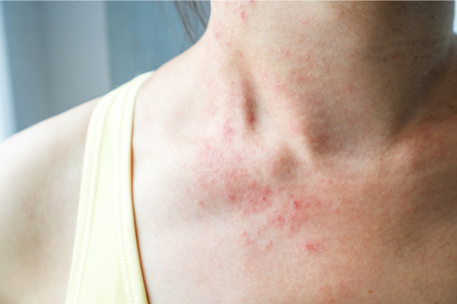 Nguyên nhân bị ngứa da cổ bất thường và cách khắc phục