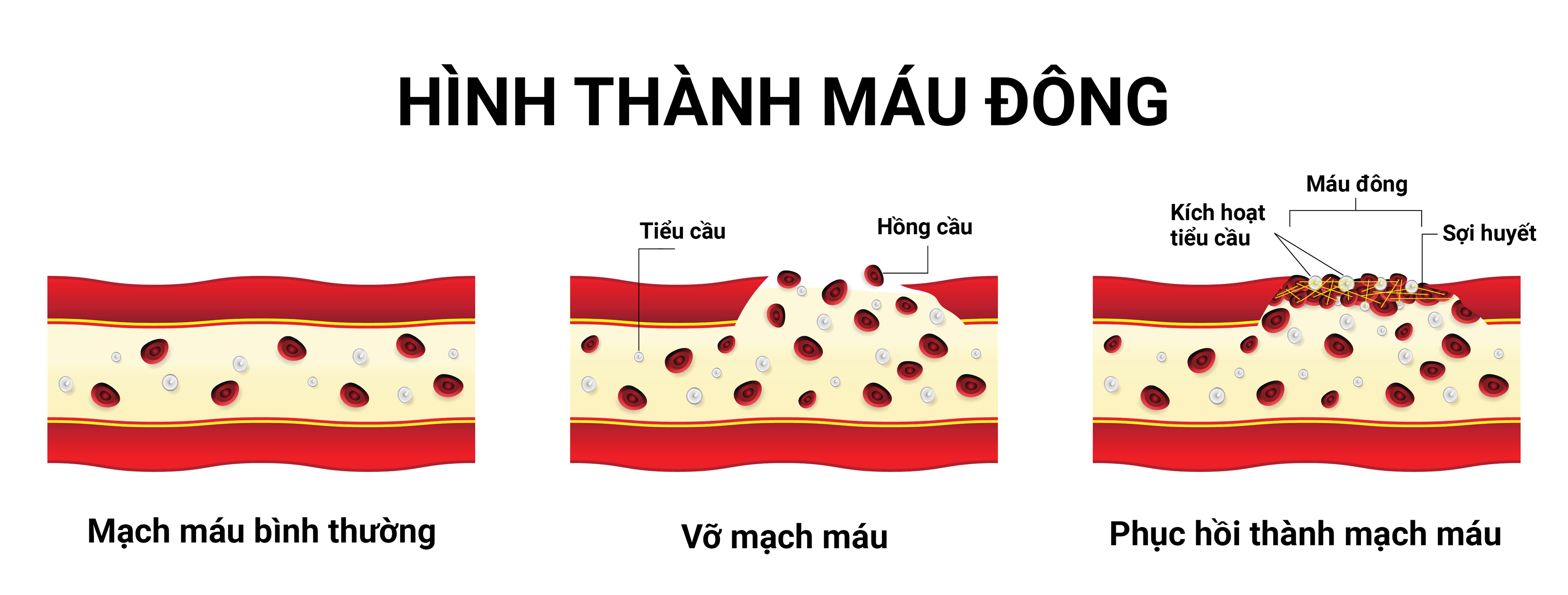 Phẫu thuật cột sống gây đông máu