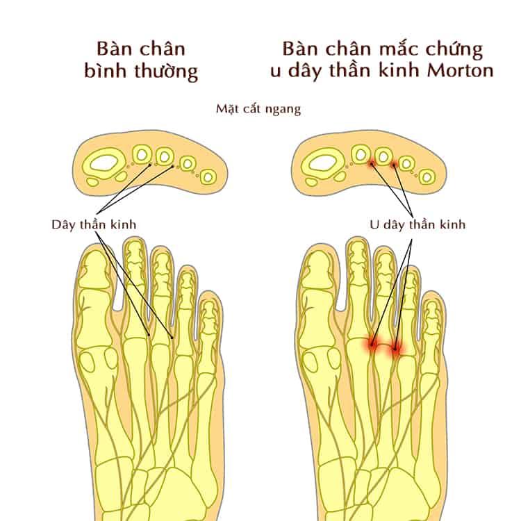 u dây thần kinh morton