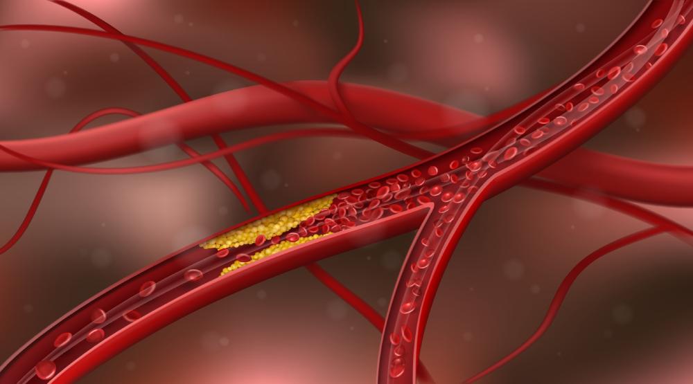 cholesterol toàn phần bất thường