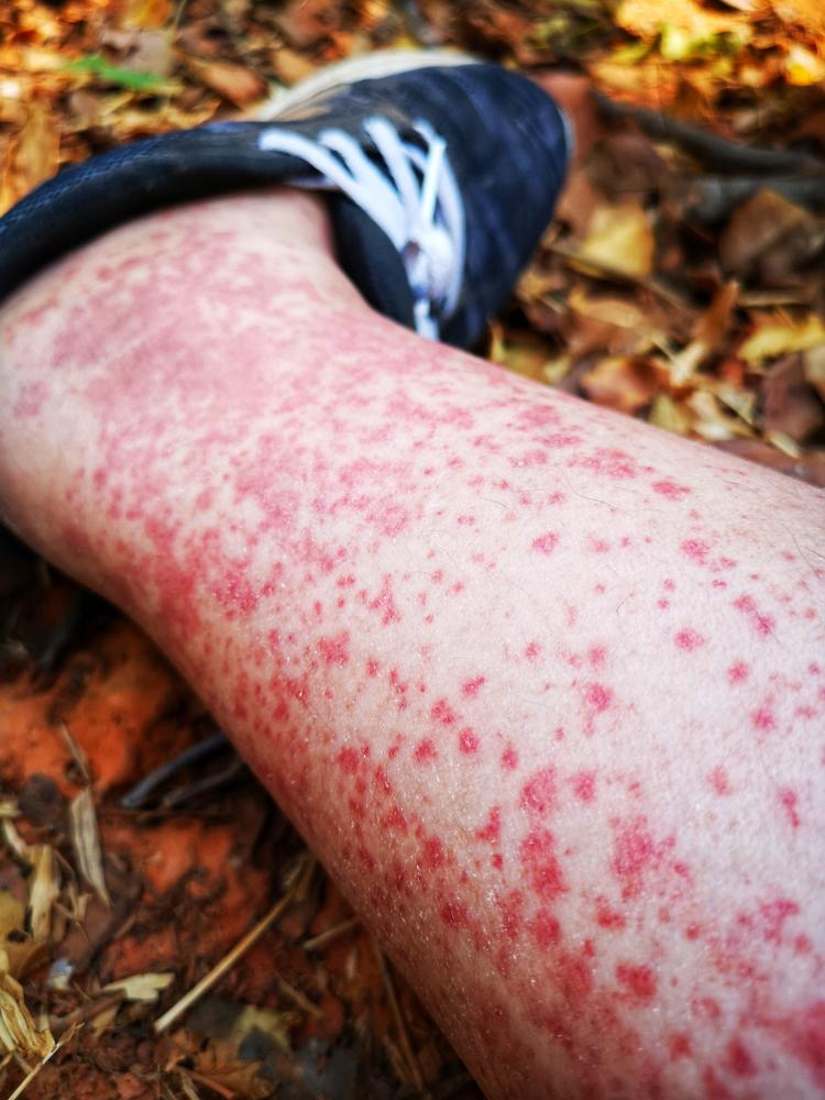 Giả đáp: Viêm mao mạch dị ứng có chữa được không?