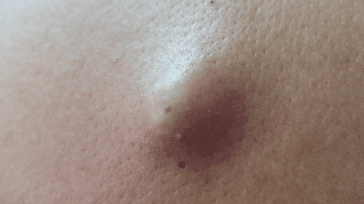 mụn nang là dạng mụn trứng cá