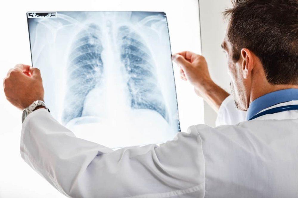 U hạt phổi và những điều bạn cần biết