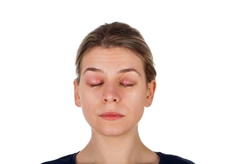 Bật mí cách chữa chắp mắt nhanh nhất