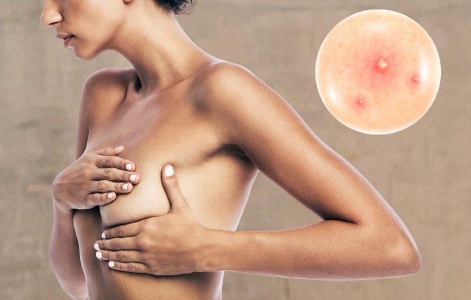 4 nhóm nguyên nhân phổ biến khiến nhũ hoa có đốm trắng