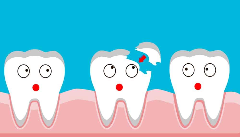6 nguyên nhân khiến răng sứ bị mẻ và cách khắc phục