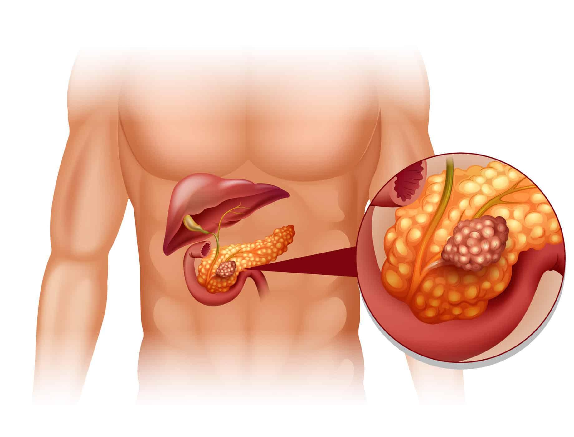 Ung thư tuyến tụy sống được bao lâu?