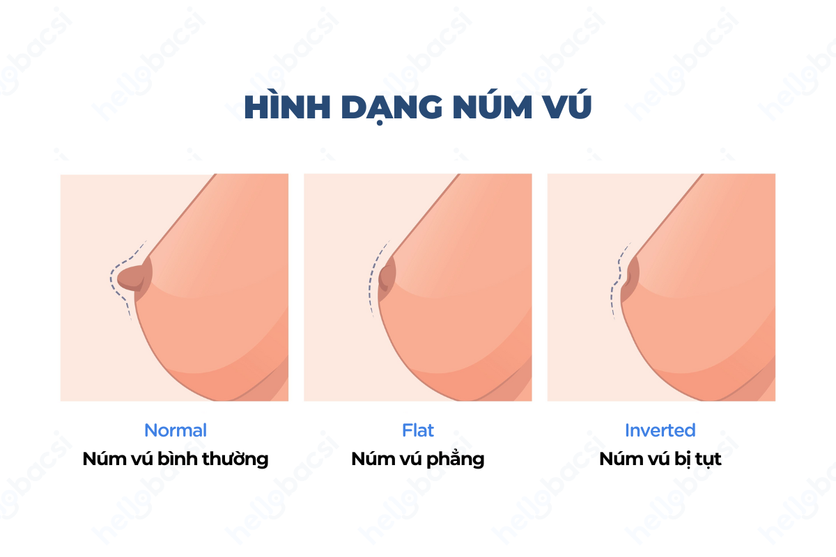 Hình dạng núm vú