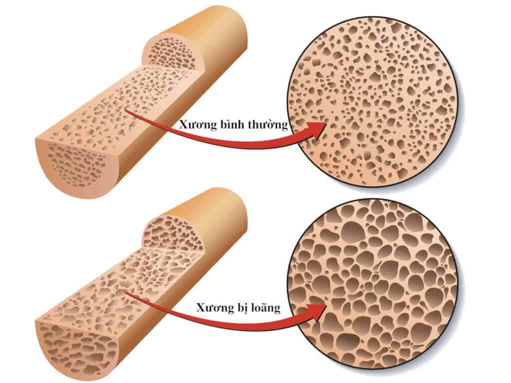 Mất cân bằng hormone là nguyên nhân gây loãng xương có thể kiểm soát