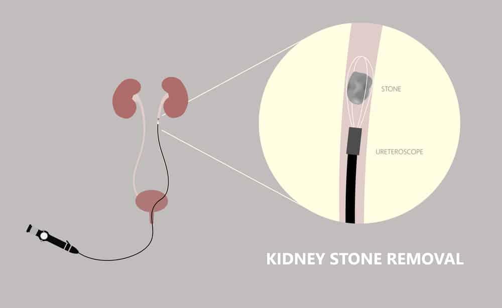 Điều trị sỏi niệu quản bằng nội soi