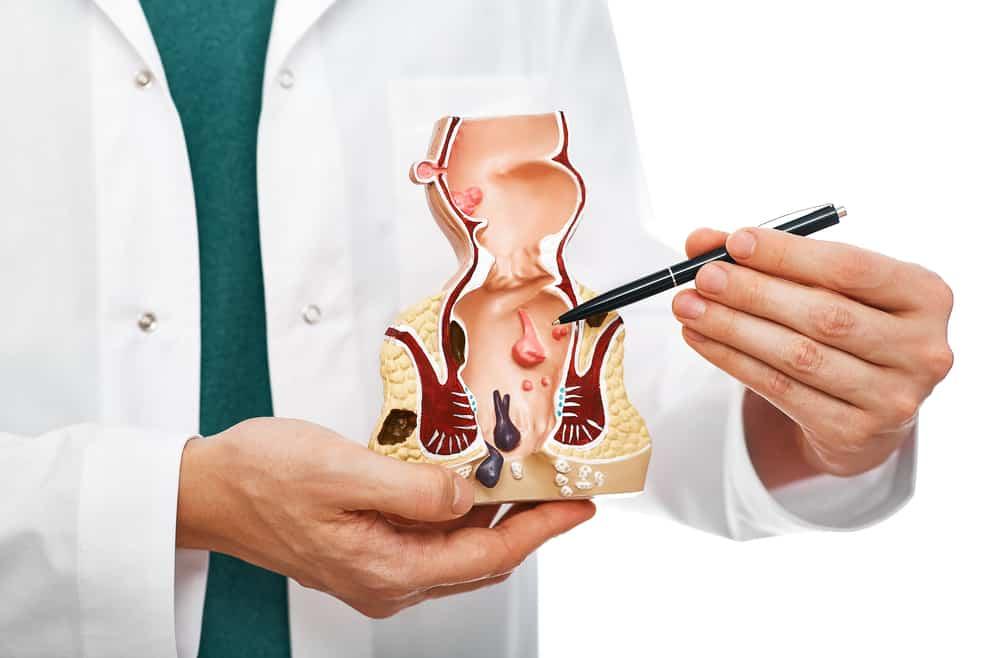 Ung thư trực tràng giai đoạn 2: Điều trị như thế nào hiệu quả?