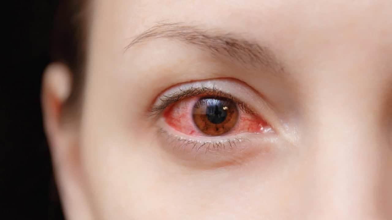 Viêm giác mạc chấm nông