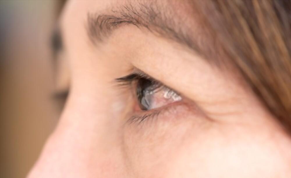 Cách chăm sóc mắt sau khi mổ mộng thịt giúp mau lành, tránh tái phát