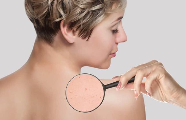 Nổi đốm đỏ trên da không ngứa là bệnh gì? Những nguyên nhân không thể bỏ qua