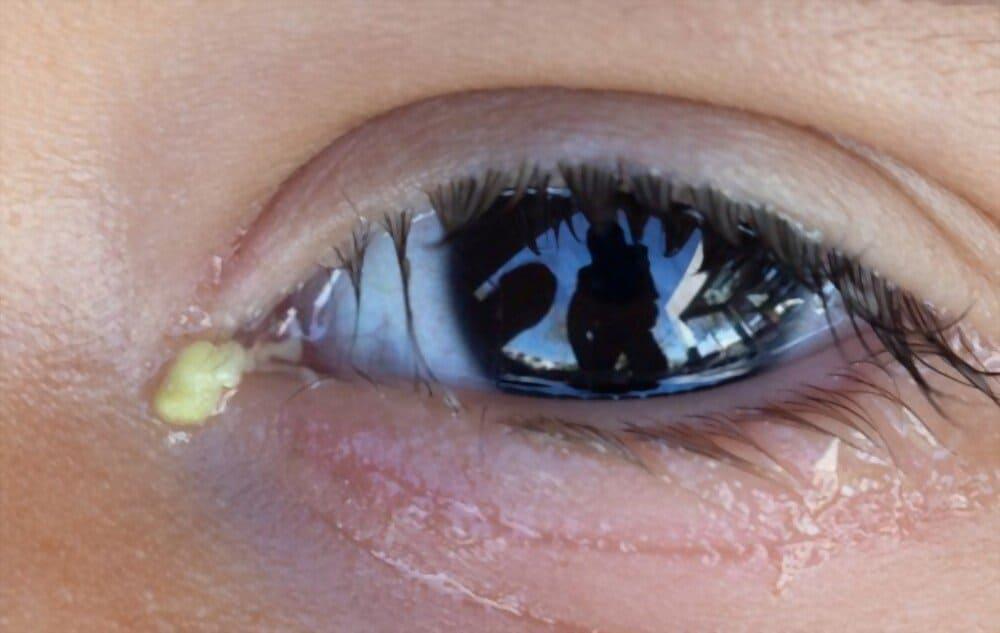 Cách chữa mắt đổ ghèn ở người lớn và trẻ cần biết nguyên nhân trước