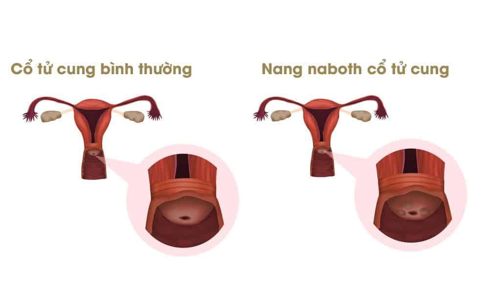 Nang naboth cổ tử cung là gì? Nguyên nhân, hình ảnh & cách điều trị