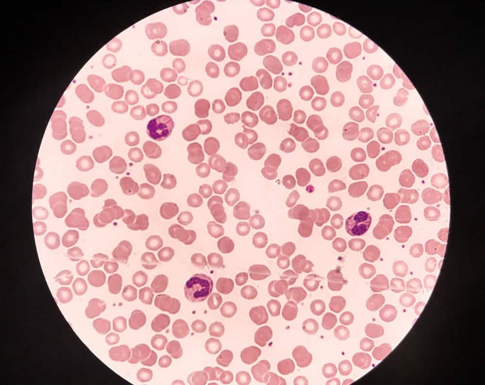 Thiếu máu tán huyết là bệnh gì? Nguyên nhân, triệu chứng và điều trị