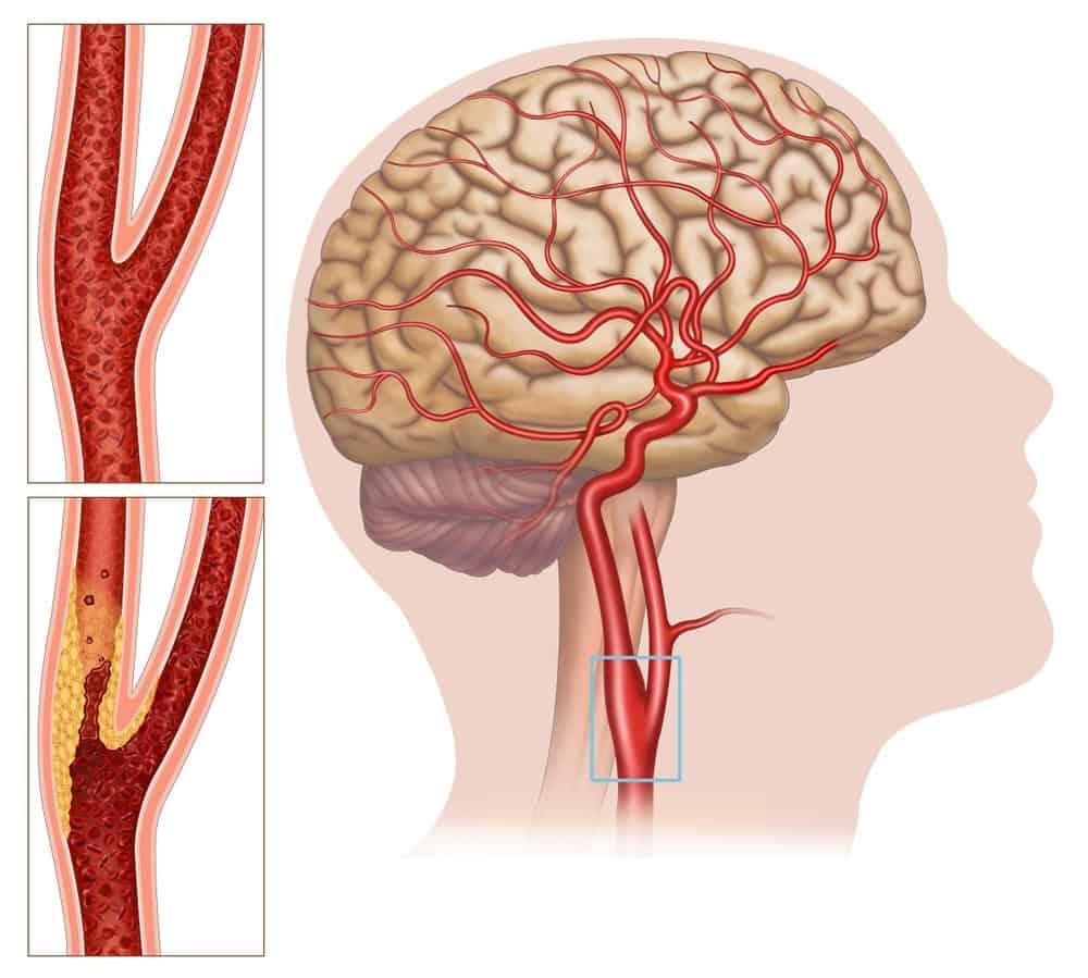 Bệnh động mạch cảnh có thể dẫn đến đột quỵ, bạn đã biết chưa?