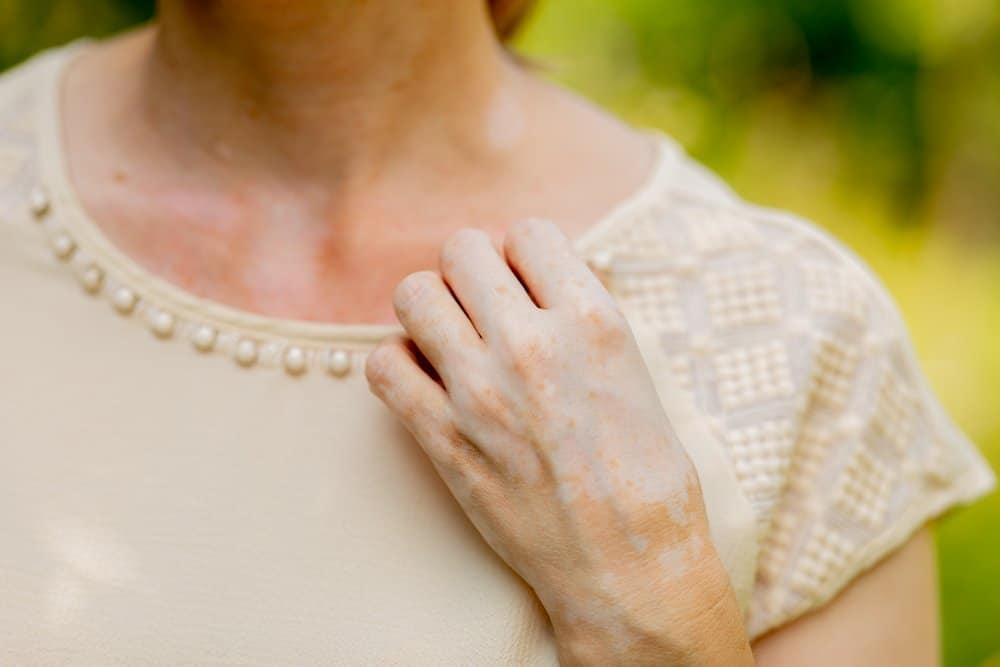 Nám da tay: Nguyên nhân và 7 cách điều trị tại nhà