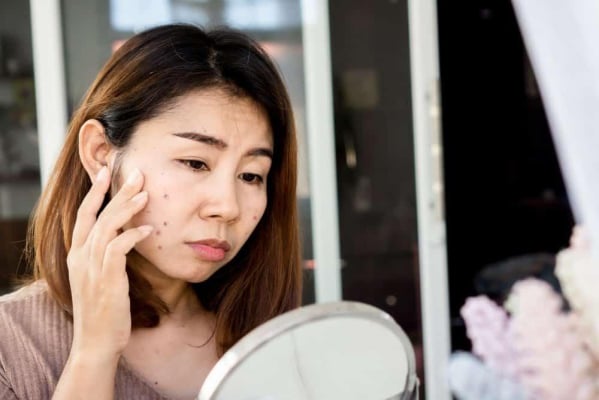  trị thâm mụn cấp tốc sau 1 đêm 