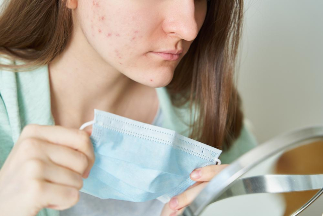 Đeo khẩu trang bị mụn: Làm sao để khắc phục?