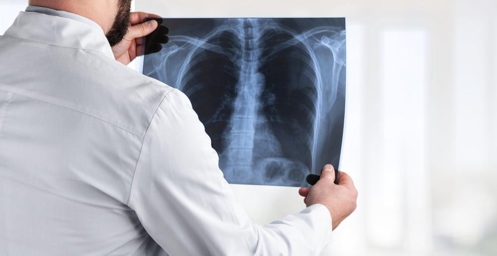 Viêm phế quản cấp có nguy hiểm không? Biến chứng và phòng ngừa